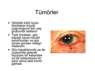 Tümörler  Gözdeki kötü huylu tümörlerin büyük çoğunluğuna ileri yaş grubunda rastlanır Tipik örnekler- göz kapağı bazal hücreli karsinomları ve göz içinde görülen malign melanom Göz kapaklarında ya da yüzeyinde giderek büyüyen bir kabarıklık ya da iyileşmeyen bir yara varsa akla tümör gelmeli 