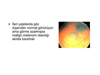 İleri yaşlılarda göz dışarıdan normal görünüyor ama görme azalmışsa malign melanom olasılığı akılda tutulmalı 