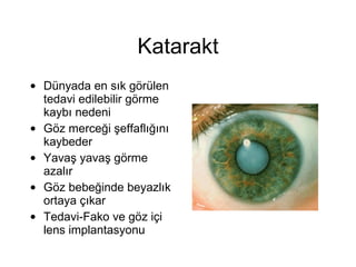 Katarakt Dünyada en sık görülen tedavi edilebilir görme kaybı nedeni Göz merceği şeffaflığını kaybeder Yavaş yavaş görme azalır Göz bebeğinde beyazlık ortaya çıkar Tedavi-Fako ve göz içi lens implantasyonu 