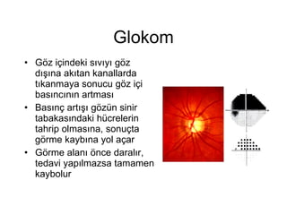 Glokom Göz içindeki sıvıyı göz dışına akıtan kanallarda tıkanmaya sonucu göz içi basıncının artması  Basınç artışı gözün sinir tabakasındaki hücrelerin tahrip olmasına, sonuçta görme kaybına yol açar  Görme alanı önce daralır, tedavi yapılmazsa tamamen kaybolur 