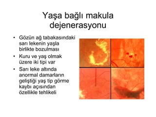 Yaşa bağlı makula dejenerasyonu Gözün ağ tabakasındaki sarı lekenin yaşla birlikte bozulması Kuru ve yaş olmak üzere iki tipi var Sarı leke altında anormal damarların geliştiği yaş tip görme kaybı açısından özellikle tehlikeli 
