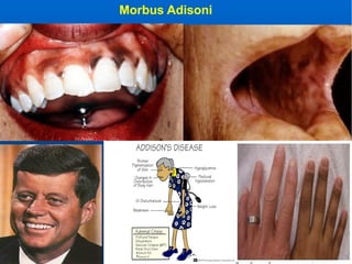 Morbus Adisoni
 