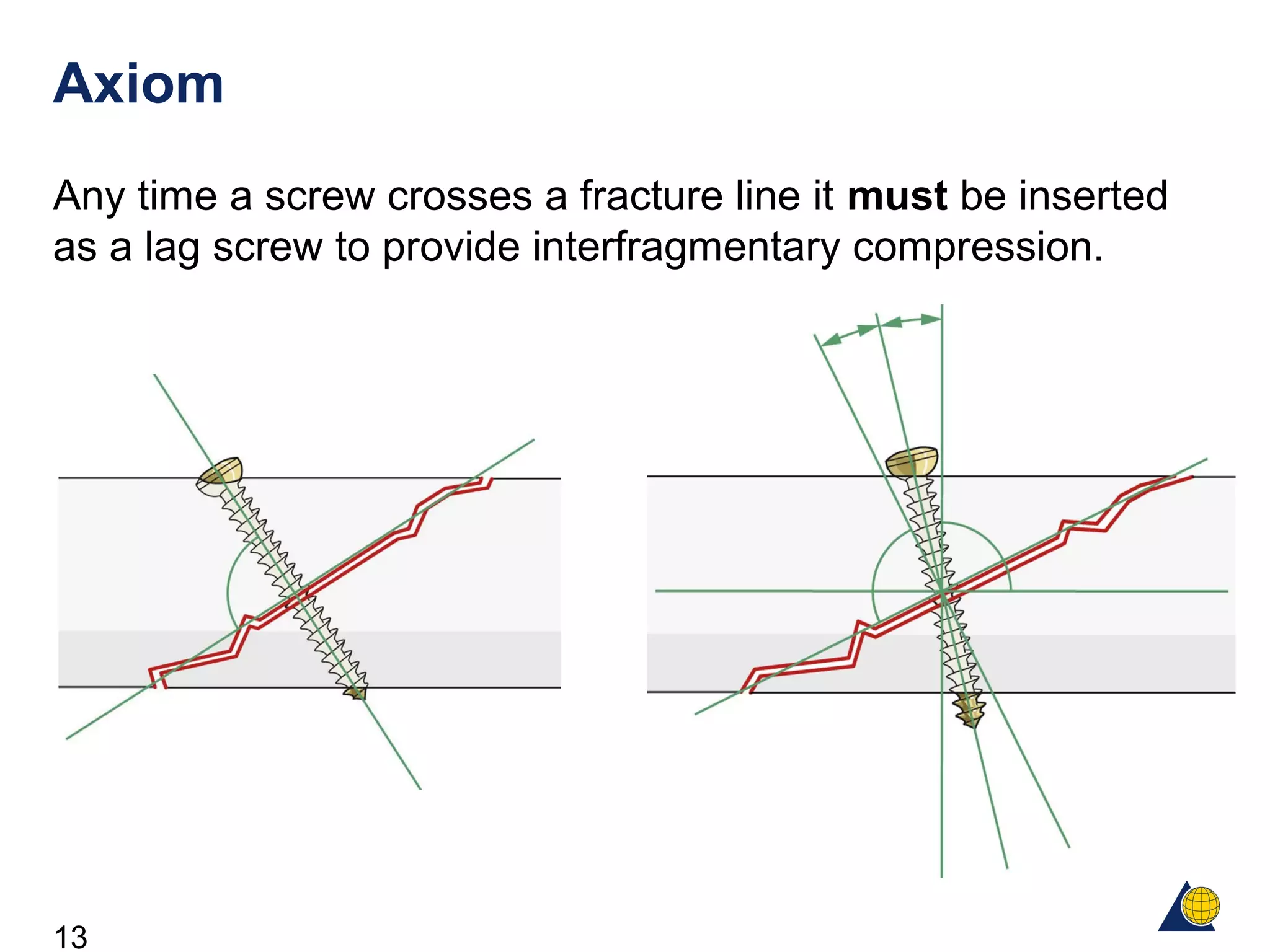 13
Axiom
Any time a screw crosses a fracture line it must be inserted
as a lag screw to provide interfragmentary compression.
 
