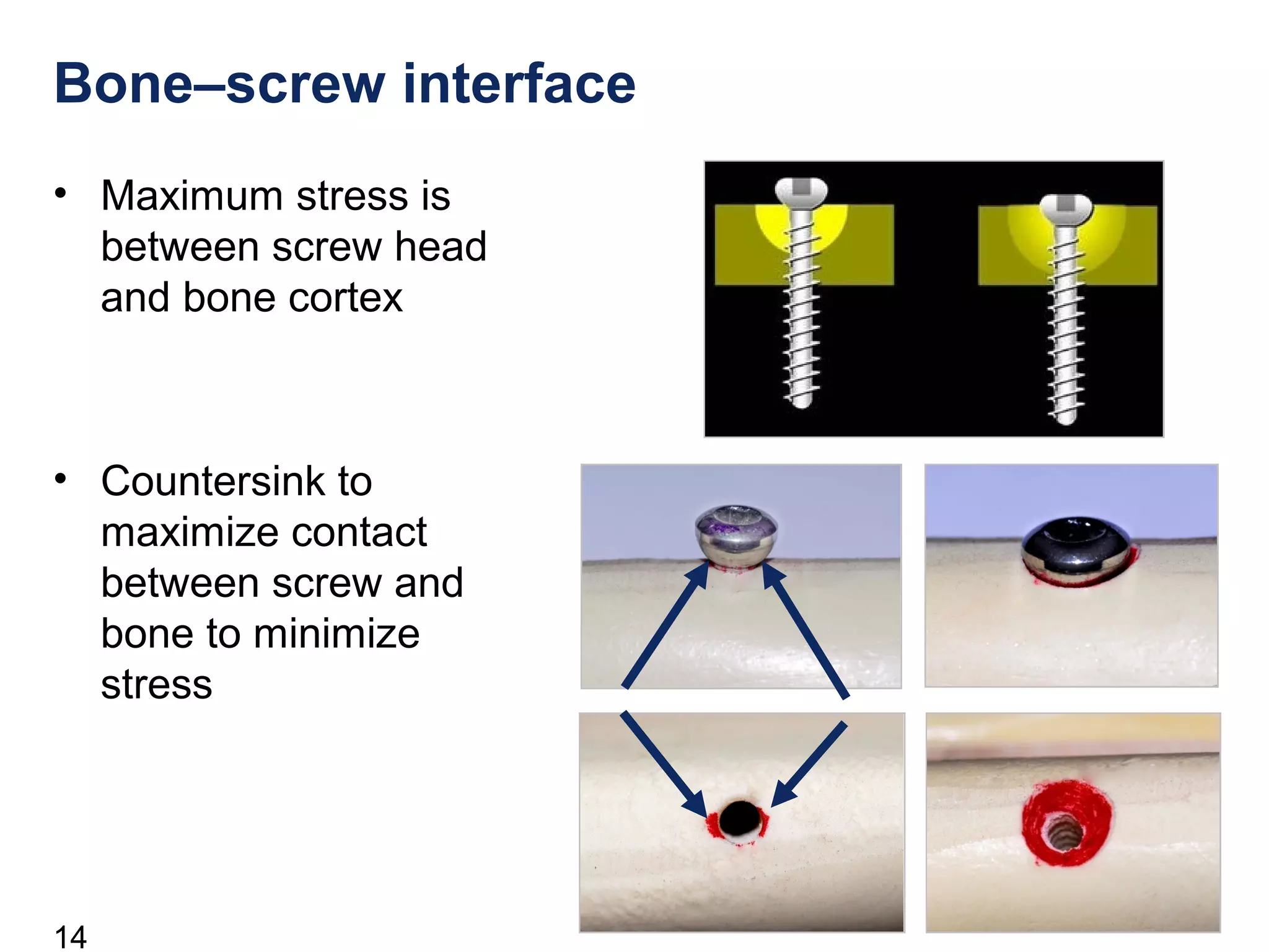 14
Bone–screw interface
• Maximum stress is
between screw head
and bone cortex
• Countersink to
maximize contact
between screw and
bone to minimize
stress
 