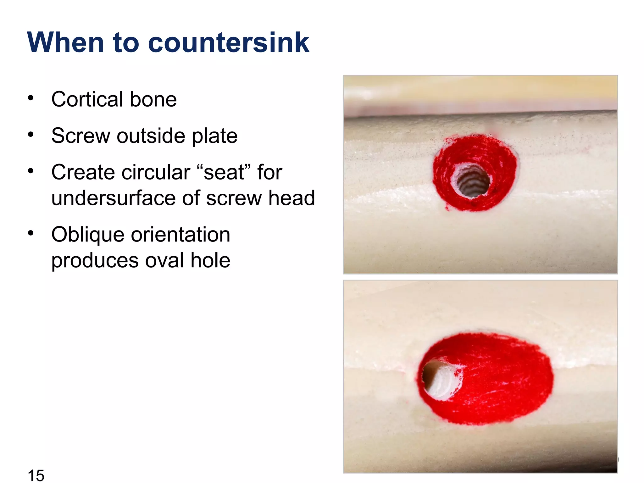 15
When to countersink
• Cortical bone
• Screw outside plate
• Create circular “seat” for
undersurface of screw head
• Oblique orientation
produces oval hole
 