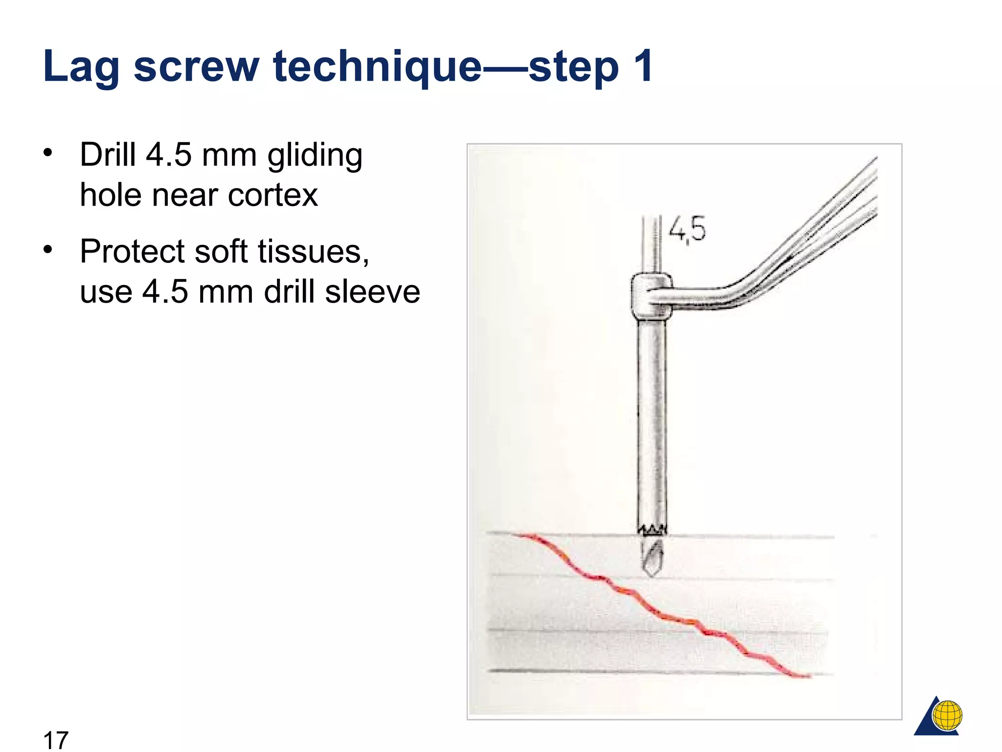 17
Lag screw technique—step 1
• Drill 4.5 mm gliding
hole near cortex
• Protect soft tissues,
use 4.5 mm drill sleeve
 