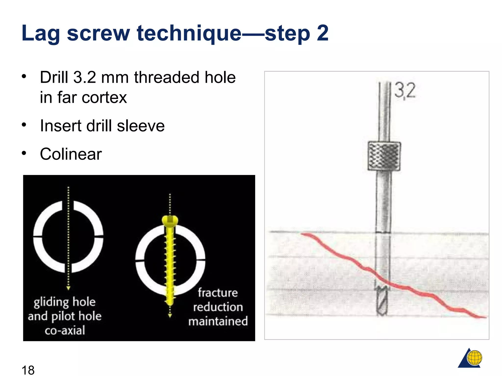 18
Lag screw technique—step 2
• Drill 3.2 mm threaded hole
in far cortex
• Insert drill sleeve
• Colinear
 