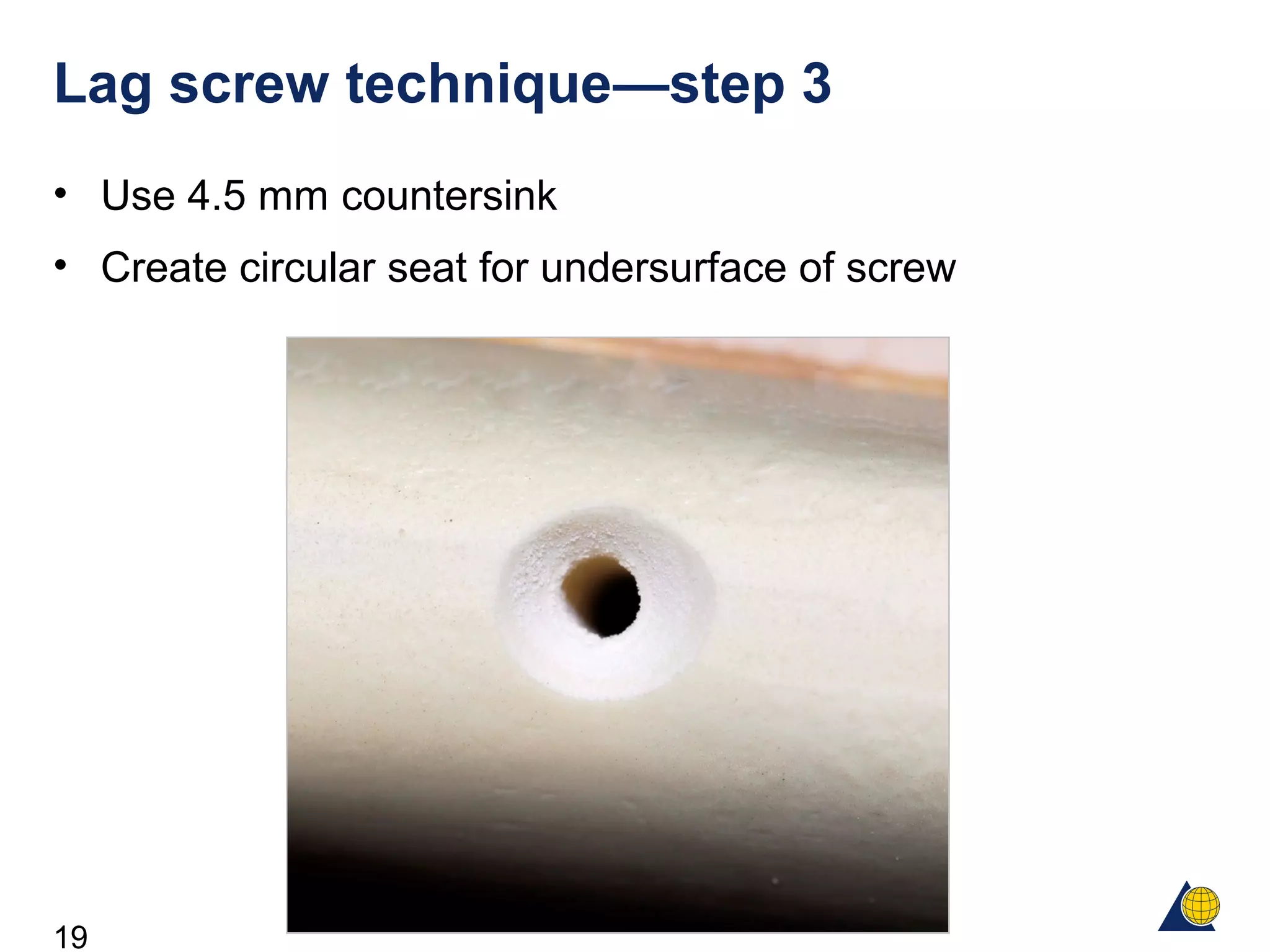 19
Lag screw technique—step 3
• Use 4.5 mm countersink
• Create circular seat for undersurface of screw
 