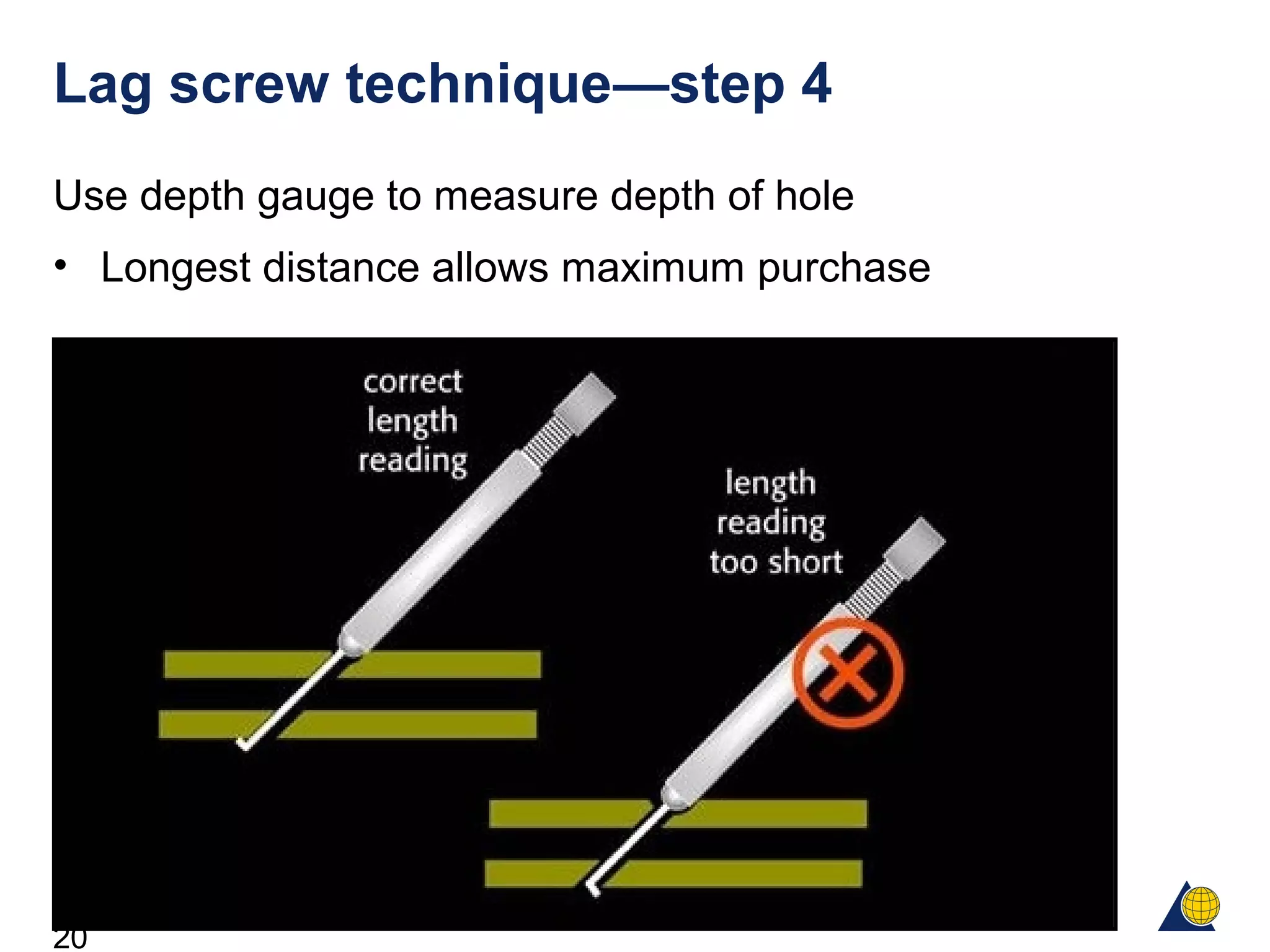 20
Lag screw technique—step 4
Use depth gauge to measure depth of hole
• Longest distance allows maximum purchase
 