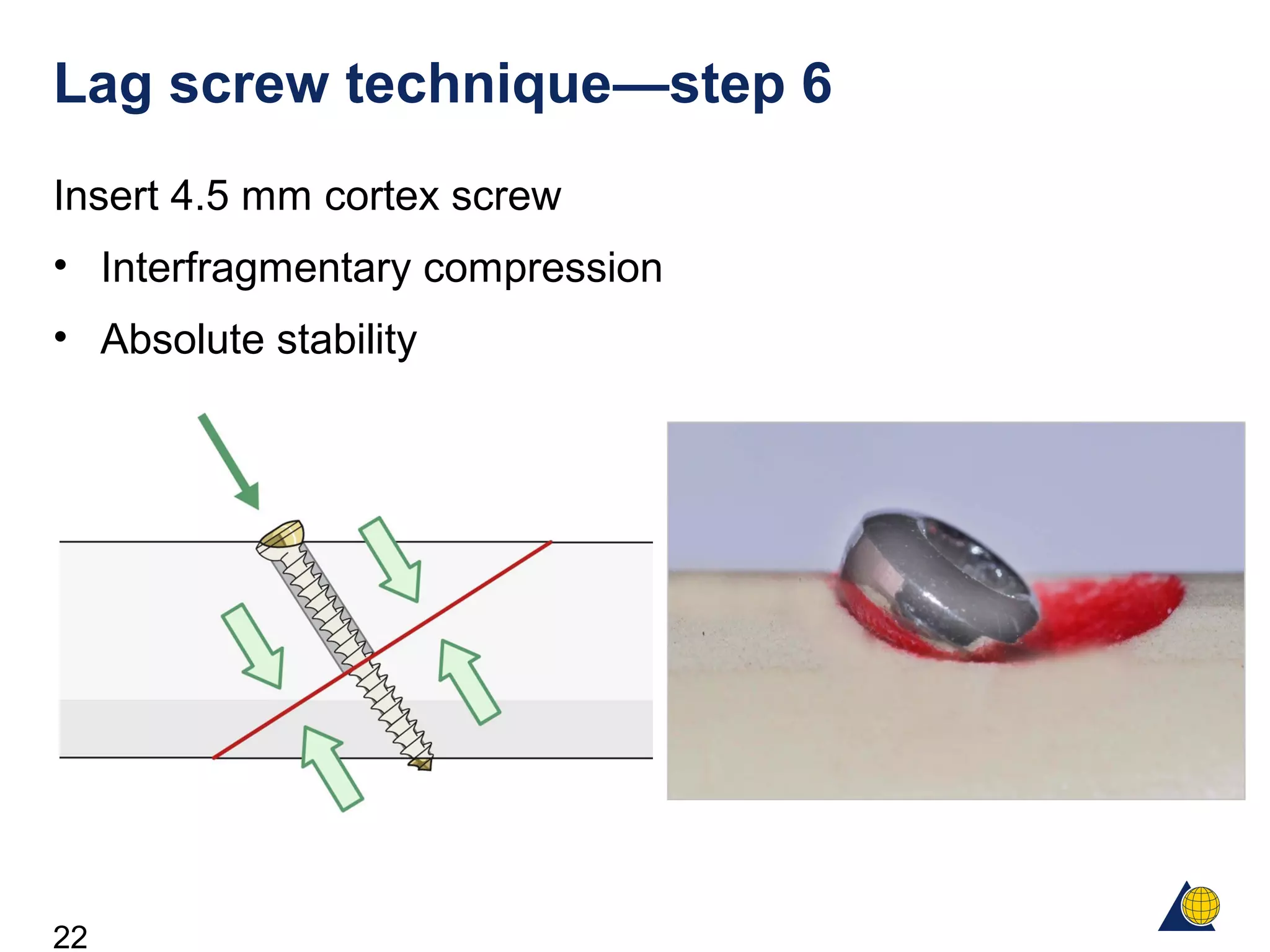 22
Lag screw technique—step 6
Insert 4.5 mm cortex screw
• Interfragmentary compression
• Absolute stability
 