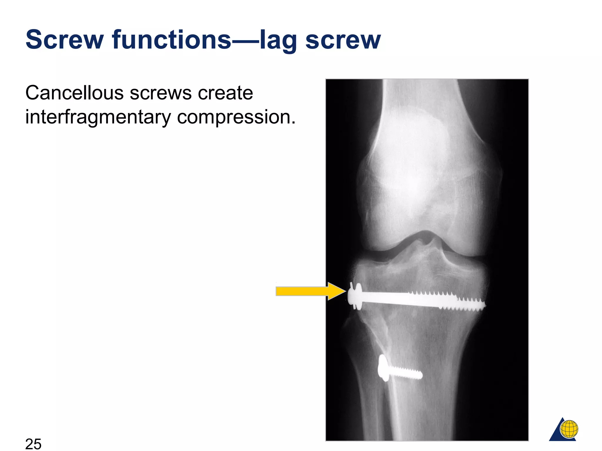 25
Screw functions—lag screw
Cancellous screws create
interfragmentary compression.
 