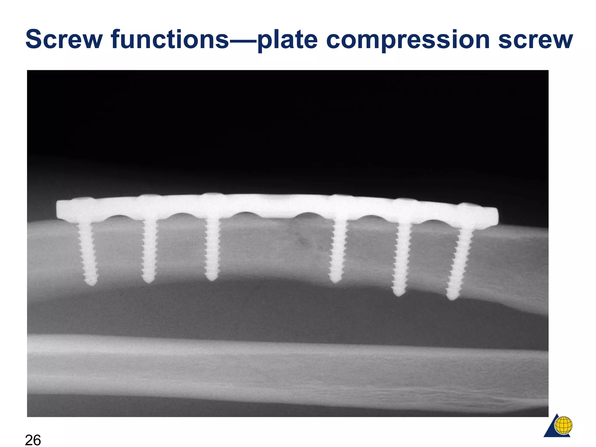 26
Screw functions—plate compression screw
 