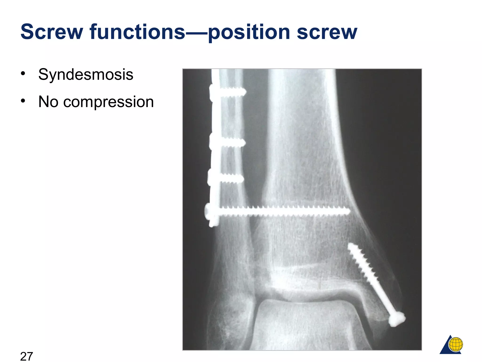 27
Screw functions—position screw
• Syndesmosis
• No compression
 