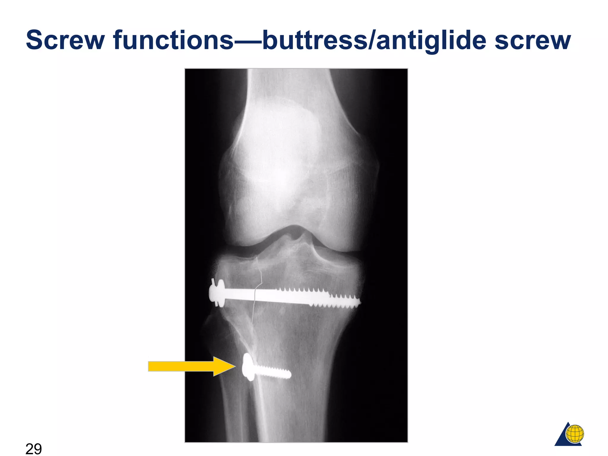 29
Screw functions—buttress/antiglide screw
 