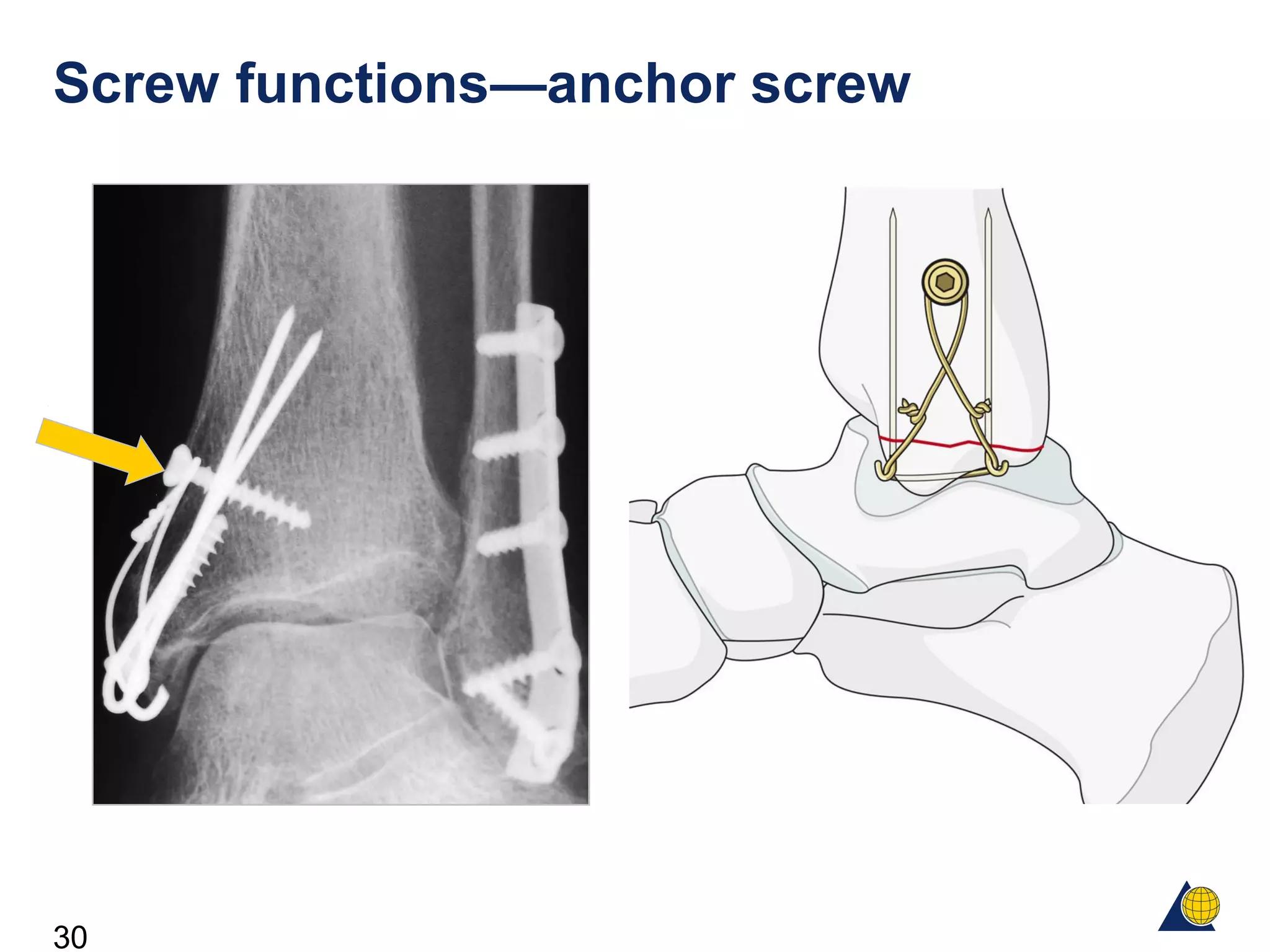 30
Screw functions—anchor screw
 