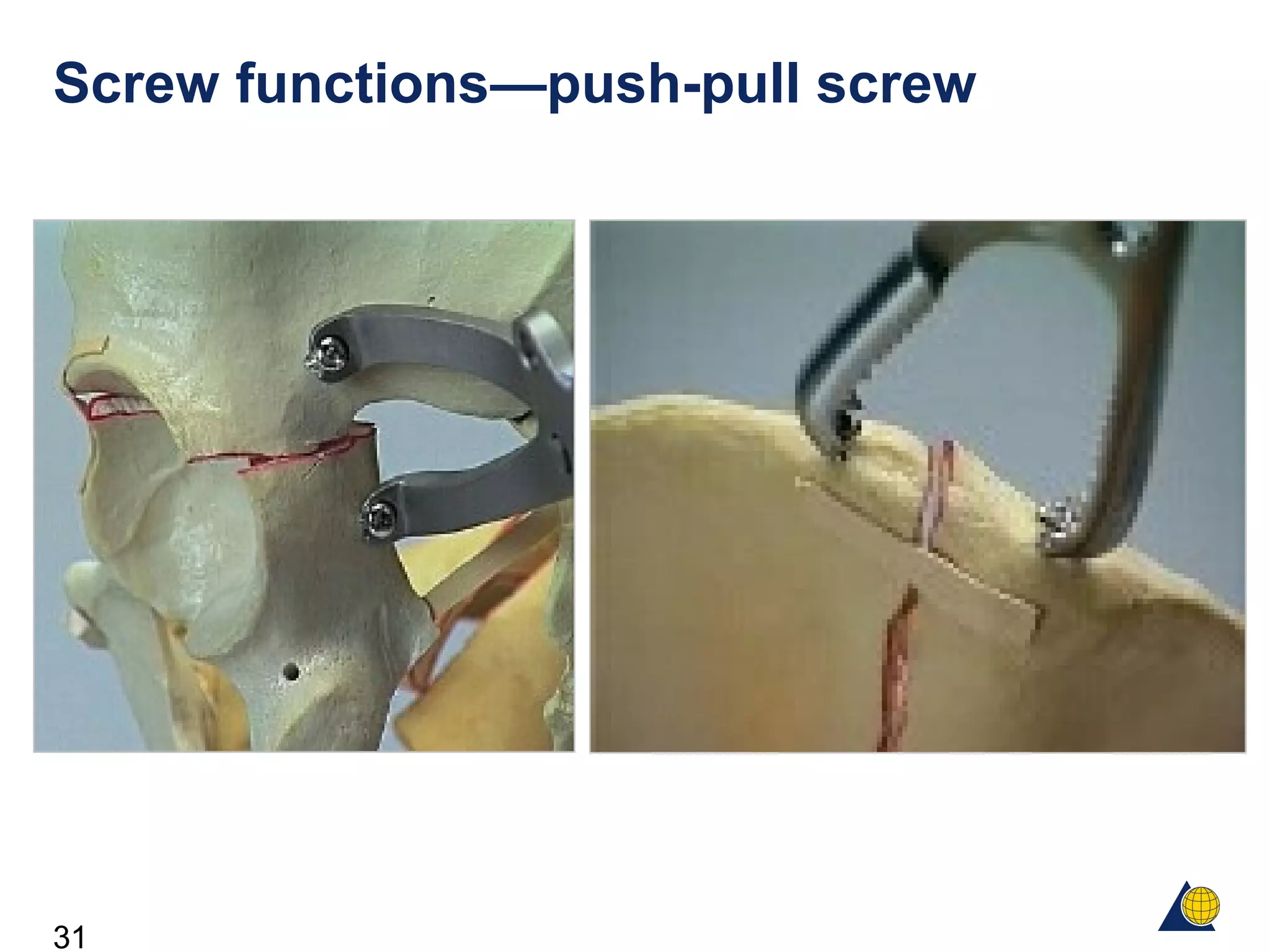 31
Screw functions—push-pull screw
 