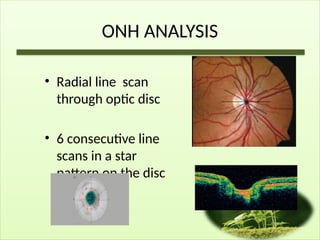 ONH ANALYSIS
• Radial line scan
through optic disc
• 6 consecutive line
scans in a star
pattern on the disc
 