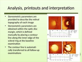 Analysis, printouts and interpretation
• Stereometric parameters are
provided to describe the retinal
topography of each image
• Stereometric parameters are
obtained within the optic disc
margin, which is defined
manually by placing a contour
line along the inner edge of the
scleral ring at the baseline
examination
• The contour line is automati-
cally transferred to all follow-up
examinations
 