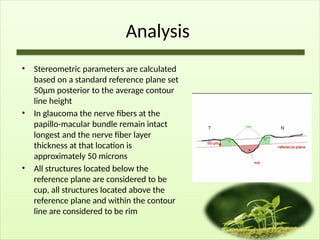 Analysis
• Stereometric parameters are calculated
based on a standard reference plane set
50µm posterior to the average contour
line height
• In glaucoma the nerve fibers at the
papillo-macular bundle remain intact
longest and the nerve fiber layer
thickness at that location is
approximately 50 microns
• All structures located below the
reference plane are considered to be
cup, all structures located above the
reference plane and within the contour
line are considered to be rim
 