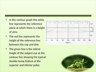 • In the contour graph the white
line represents the reference
plane at which there is a height
of zero.
• The red line represents the
height of the reference line
between the cup and disk.
• The green line is the retinal
height of the subject eye at the
contour line showing the typical
double hump feature at the
superior and inferior poles.
 