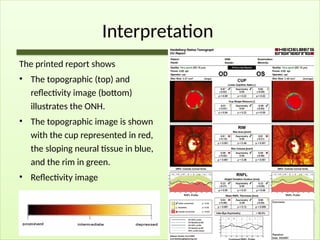 Interpretation
The printed report shows
• The topographic (top) and
reflectivity image (bottom)
illustrates the ONH.
• The topographic image is shown
with the cup represented in red,
the sloping neural tissue in blue,
and the rim in green.
• Reflectivity image
 