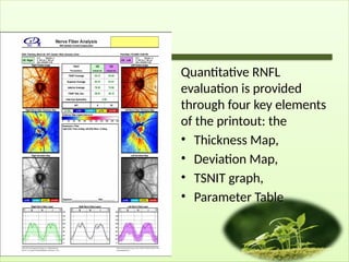 Quantitative RNFL
evaluation is provided
through four key elements
of the printout: the
• Thickness Map,
• Deviation Map,
• TSNIT graph,
• Parameter Table
 