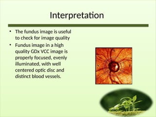 Interpretation
• The fundus image is useful
to check for image quality
• Fundus image in a high
quality GDx VCC image is
properly focused, evenly
illuminated, with well
centered optic disc and
distinct blood vessels.
 