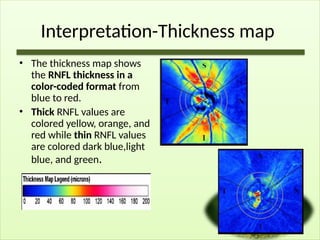 Interpretation-Thickness map
• The thickness map shows
the RNFL thickness in a
color-coded format from
blue to red.
• Thick RNFL values are
colored yellow, orange, and
red while thin RNFL values
are colored dark blue,light
blue, and green.
 