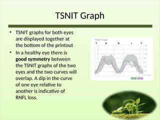TSNIT Graph
• TSNIT graphs for both eyes
are displayed together at
the bottom of the printout
• In a healthy eye there is
good symmetry between
the TSNIT graphs of the two
eyes and the two curves will
overlap. A dip in the curve
of one eye relative to
another is indicative of
RNFL loss.
 