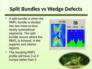Split Bundles vs Wedge Defects
• A split bundle is when the
RNFL bundle is divided
into two more-or-less
nearly symmetrical
segments. The split
bundle occurs where the
RNFL is thickest, in the
superior and inferior
regions
• The resulting RNFL
profile will have 3 or 4
humps rather than 2
 