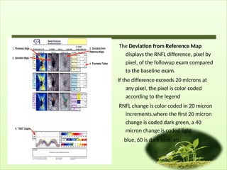 The Deviation from Reference Map
displays the RNFL difference, pixel by
pixel, of the followup exam compared
to the baseline exam.
If the difference exceeds 20 microns at
any pixel, the pixel is color coded
according to the legend
RNFL change is color coded in 20 micron
increments,where the first 20 micron
change is coded dark green, a 40
micron change is coded light
blue, 60 is dark blue, etc.
 
