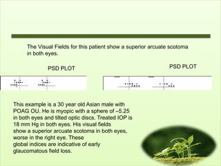 The Visual Fields for this patient show a superior arcuate scotoma
in both eyes.
PSD PLOT PSD PLOT
This example is a 30 year old Asian male with
POAG OU. He is myopic with a sphere of –5.25
in both eyes and tilted optic discs. Treated IOP is
18 mm Hg in both eyes. His visual fields
show a superior arcuate scotoma in both eyes,
worse in the right eye. These
global indices are indicative of early
glaucomatous field loss.
 