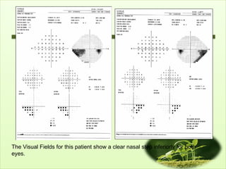 The Visual Fields for this patient show a clear nasal step inferiorly for both
eyes.
 