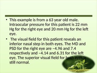 • This example is from a 63 year old male.
Intraocular pressure for this patient is 22 mm
Hg for the right eye and 20 mm Hg for the left
eye.
• The visual field for this patient reveals an
inferior nasal step in both eyes. The MD and
PSD for the right eye are –4.96 and 7.4
respectively and –4.14 and 6.31 for the left
eye. The superior visual field for both eyes is
still normal.
 