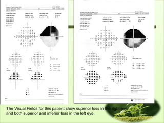 The Visual Fields for this patient show superior loss in the right eye
and both superior and inferior loss in the left eye.
 