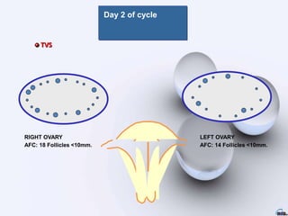 Day 2 of cycle
RIGHT OVARY
AFC: 18 Follicles <10mm.
TVS
LEFT OVARY
AFC: 14 Follicles <10mm.
 