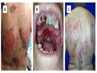 [Chronic Multiple ulcers] O.Medicine lab | PDF
