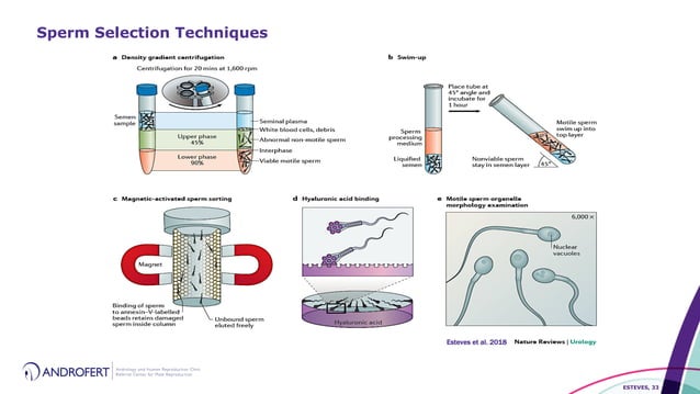 Clinical Utility of Sperm DNA Fragmentation Testing: is the jury still ...