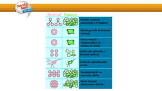 Divisões	
  celulares	
  
aumentada	
  e	
  irregulares	
  
Núcleo	
  grande	
  de	
  formato	
  
variável	
  
Pouco	
  volume	
  
citoplasmáGco	
  em	
  
relação	
  ao	
  núcleo	
  
Célula	
  com	
  tamanho	
  e	
  
formato	
  variável	
  
Perda	
  da	
  especialização	
  
celular	
  
Desorganização	
  do	
  
rearranjo	
  celular	
  
Borda	
  tumoral	
  
pobremente	
  deﬁnida	
  
 