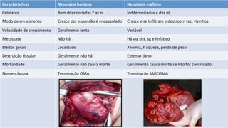 CaracterísGcas	
   Neoplasia	
  benigna	
   Neoplasia	
  maligna	
  
Celulares	
   Bem	
  diferenciadas	
  ~	
  as	
  nl	
   Indiferenciadas	
  ≠	
  das	
  nl	
  
Modo	
  de	
  crescimento	
   Cresce	
  por	
  expansão	
  é	
  encapsulado	
   Cresce	
  e	
  se	
  inﬁltram	
  e	
  destroem	
  tec.	
  vizinhos	
  
Velocidade	
  de	
  crescimento	
   Geralmente	
  lenta	
   Variável	
  	
  
Metástase	
  	
   Não	
  há	
   Há	
  via	
  sist.	
  sg	
  e	
  linfá:co	
  
Efeitos	
  gerais	
   Localizado	
  	
   Anemia,	
  fraqueza,	
  perda	
  de	
  peso	
  
Destruição	
  :ssular	
   Geralmente	
  não	
  há	
   Extenso	
  dano	
  	
  
Mortalidade	
  	
   Geralmente	
  não	
  causa	
  morte	
   Geralmente	
  causa	
  morte	
  se	
  não	
  for	
  controlado	
  
Nomenclatura	
  	
   Terminação	
  OMA	
   Terminação	
  SARCOMA	
  
	
  
	
  
	
  
	
  
	
  
	
  
	
  
	
  
 