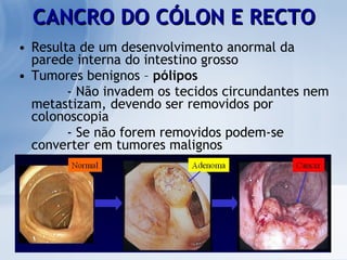 CANCRO DO CÓLON E RECTO Resulta de um desenvolvimento anormal da parede interna do intestino grosso Tumores benignos –  pólipos - Não invadem os tecidos circundantes nem metastizam, devendo ser removidos por colonoscopia - Se não forem removidos podem-se converter em tumores malignos 