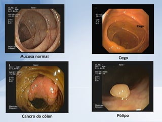 Cancro do cólon Cego Mucosa normal Pólipo 