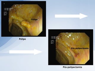 Pólipo Pós-polipectomia 