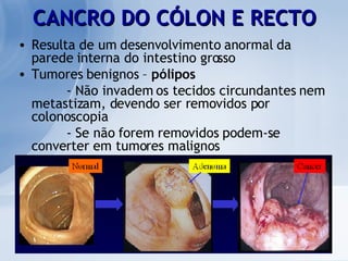 CANCRO DO CÓLON E RECTO Resulta de um desenvolvimento anormal da parede interna do intestino grosso Tumores benignos –  pólipos - Não invadem os tecidos circundantes nem metastizam, devendo ser removidos por colonoscopia - Se não forem removidos podem-se converter em tumores malignos 