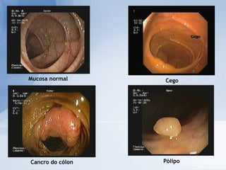 Cancro do cólon Cego Mucosa normal Pólipo 