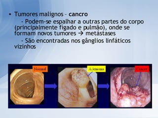 Tumores malignos –  cancro - Podem-se espalhar a outras partes do corpo (principalmente fígado e pulmão), onde se formam novos tumores    metástases - São encontradas nos gânglios linfáticos vizinhos 