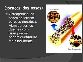 Doenças dos ossos: Osteoporose: os ossos se tornam oorosos (furados). Além de dor, os doentes com osteoporose podem quebrar-se  mais facilmente. 