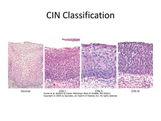 CIN and Cervical Screening | PPTX