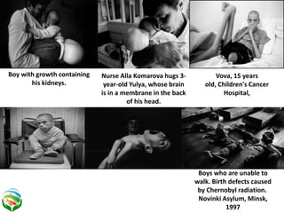 Boy with growth containing
his kidneys.
Nurse Alla Komarova hugs 3-
year-old Yulya, whose brain
is in a membrane in the back
of his head.
Vova, 15 years
old, Children's Cancer
Hospital,
Boys who are unable to
walk. Birth defects caused
by Chernobyl radiation.
Novinki Asylum, Minsk,
1997
 