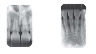 Periapical Radiopacity Classification periapical radiopacities | PPTX